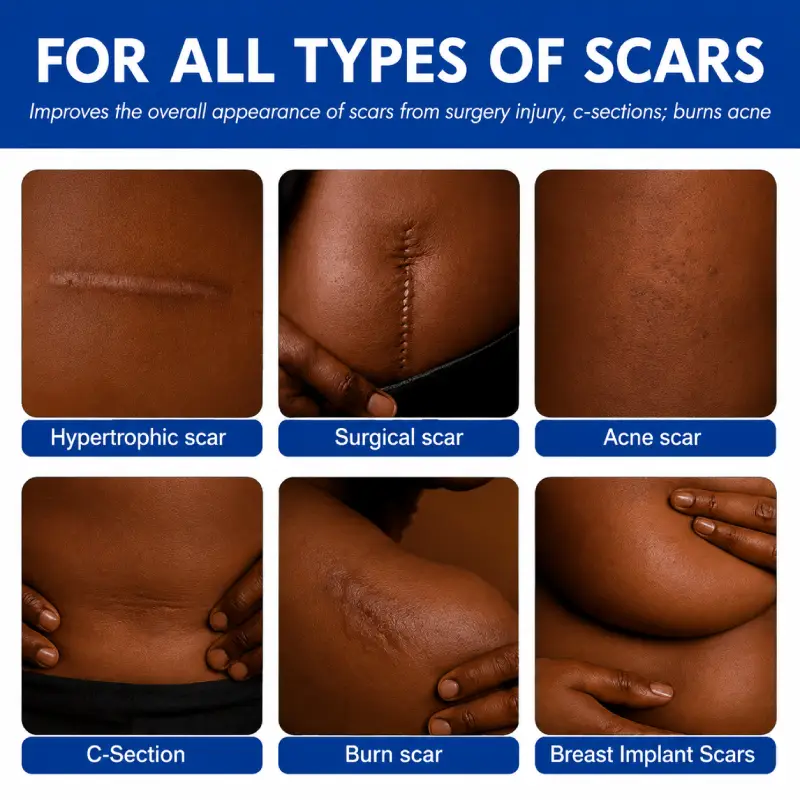 MOOYM scar removal Ointment 3