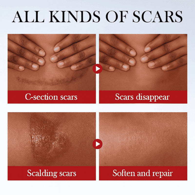 scarclear 4